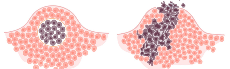 Breast Cancer Classification